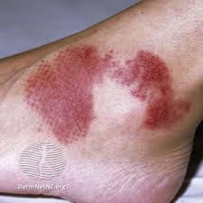Low platelet (a blood cell that stops your body from bleeding) levels. Triage Detect Disease In A Snap