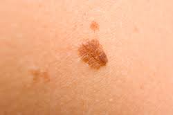 Brown or black streak under a nail. Basic Information About Skin Cancer Cdc