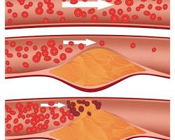 person's blood vessel with cholesterol buildupの画像