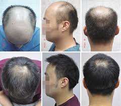 For more incredible before and after photos, backed up by hd video of the patients, click here: Should We Do Hair Transplantation In The Poor Candidate Springerlink