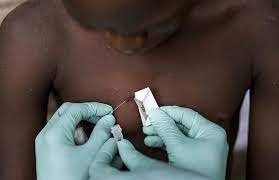 The virus is found mainly in tropical rainforest regions of central and west africa. What Is Monkeypox Outbreak In Wales What Are The Symptoms Express Co Uk