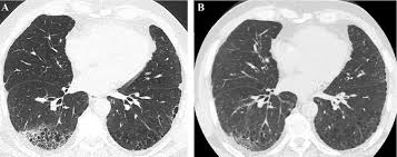 La fibrosis pulmonar idiopática (fpi) es el tipo más común de fp y no tiene causa conocida. Tomografia Computada De Alta Resolucion En El Diagnostico De La Fibrosis Pulmonar Idiopatica