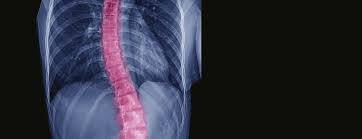 How long does scoliosis surgery take. Spinal Fusion Surgery For Scoliosis Conditions Treatments Ucsf Health