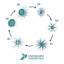 Classificação de Sakita • Endoscopia Terapeutica