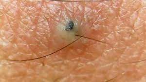 Choose a natural cream, moisturizer, or gel to lubricate the skin and reduce the chance of irritation or breakouts. Ingrown Hair Removal Youtube