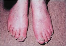 Image result for Onychotillomania feet