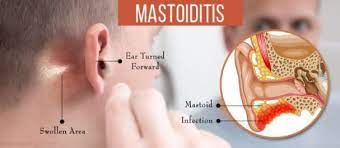 Mastoiditis Is Majorly As A Result Of An Infection In The Middle Ear This Infection Can Extend Towards The Mastoid Bone Middle Ear Ear Infection Otitis Media