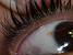 Eyebrow Hair Stuck Under Skin