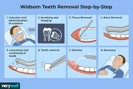 The position of the wisdom teeth in the jaw which determines the extent of surgery needed to get the wisdom teeth pulled out. Wisdom Teeth Removal Surgery Preparation And Recovery