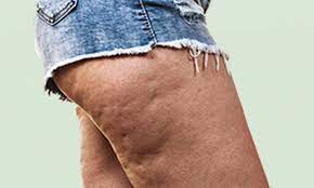 Regular smoking and alcohol consumption can. Does Collagen Help With Cellulite Flab Fix