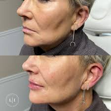 Patient wanted a more defined chin and she felt her jawline was looking  “jowly”! It's amazing what the right HA filler product can do for  correction, projection and definition! #voluma #chinforthewin @agence_spa
