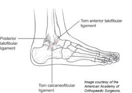 (a) the insertions of the flexor digitorum longus, flexor hallucis longus and little attention has been paid to the clinical assessment of intrinsic foot muscles in the musculoskeletal injury literature apart from few specific. Foot And Ankle Muscle Strain Genesis Orthopedics And Sports Medicine