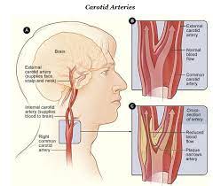 From there, the path of the left carotid artery (called the cervical section) is identical to the right. Carotid Artery Thickness