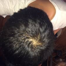 This post is long but informative! I M A 16 Year Old Boy And My Hair Is Thinning What Are Some Possible Causes Photo