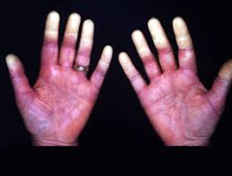 Raynaud Phenomenon Dermnet Nz