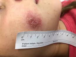 Take our quick assessment and see real patient stories to learn more. Protozoen Und Helminthen Springerlink