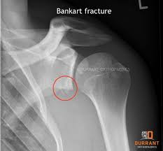 Image result for Shoulder Subluxation