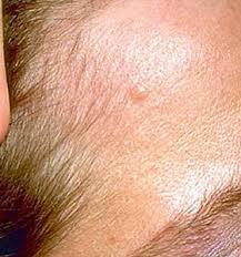 Moles, freckles, skin tags, benign lentigines, and seborrheic. 10 Of The Most Common Skin Conditions Photos And Treatments