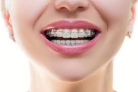 Il classico apparecchio con i brackets metallici risulta spesso poco apprezzato dai pazienti (in particolare da quelli adulti) che. Ortodonzia In Croazia Fiume Prezzi Orto Nova Medicina Dentale
