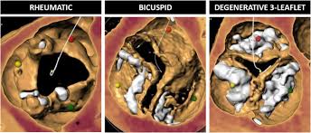 Image result for XRay Changes in Rheumatic Conditions