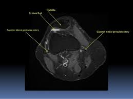 Stability of the joint is governed by a combination of static ligaments the surgeon is ill equipped to undertake surgical treatment of a dislocated knee without a sound footing in the anatomic complexities of this joint. Mri Knee Joint Anatomy