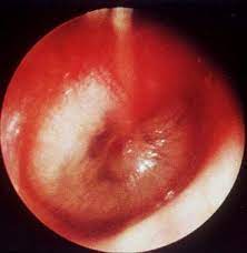 Acute otitis media (aom) presents over a course of days to weeks, typically in young children, characterised by severe pain and visible inflammation of the tympanic membrane. What Is Otitis Media Om And What Are Its Subtypes