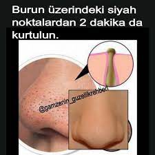 Merhabalar Arkadaslar Bugun Burun Uzerindeki Siyah Noktalardan Kurtulmak Icin Tarif Verecegim Burun Uzerindek Siyah Noktalar Ev Yapimi Cilt Bakimi Sivilce Izi