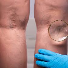 Image result for Venous Tap Test