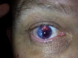 A canadian model might have to have her eyeball removed after a botched attempt to tattoo it purple left her partially blind. Cornea Medical Tattoo A Ocean Natural Tattoo Removal Solution