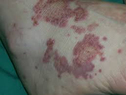 Sjogren Syndrome Dermnet Nz