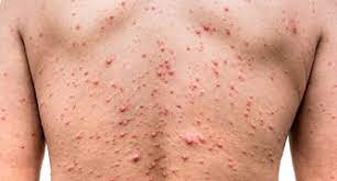 Viruserkrankung Gurtelrose Herpes Zoster Ausgabe 5 2017 Paracelsus Magazin