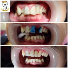 Maybe you would like to learn more about one of these? Gigi Palsu Permanen Bridge Manado Dental Kingdom Facebook