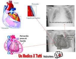 Il dolore è solitamente improvviso e acuto e può irradiarsi alle spalle, al collo, alla schiena e all'addome. Malattie Del Pericardio