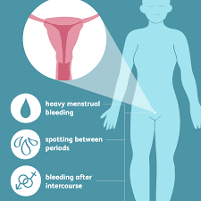If it actually is cancer, so long as it hasn't spread, they will just take. The Symptoms Of Uterine Polyps