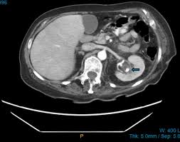 Image result for Nephrolithiasis Imaging