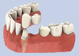 Check spelling or type a new query. Dental Bridge Affordable And Fixed Missing Teeth Replacement