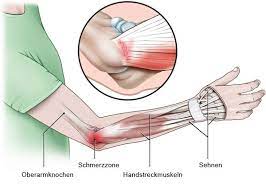 Schmerzen im ellenbogen sind bei einem tennisarm typisch. Tennisarm Tennisellenbogen Gesundheitsinformation De