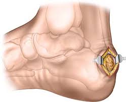 Related online courses on physioplus. Posteromedial Posterolateral And Posterior Midline Approaches For Excision Of Calcaneal Exostosis Haglund S Deformity Musculoskeletal Key