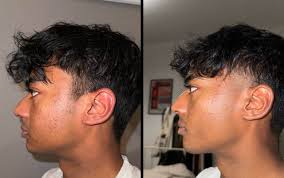 4 tháng dùng tretinoin 0.005-0.024% : r/tretinoin