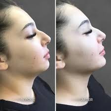 Albuquerque Chin & Jaw Before & After Gallery: Chrome Aesthetics