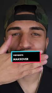 Porcelain Veneers for a Perfect Smile