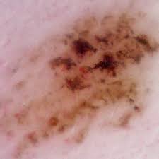We did not find results for: Skin Cancer Melanoma Signs And Symptoms Skin Cancer Images And Pictures