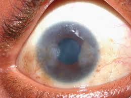 Image result for Vernal Conjunctivitis