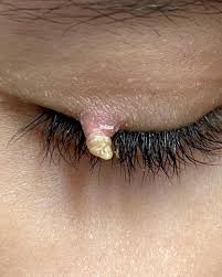 Image result for cornu cutaneum)