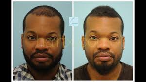 There are currently 8 fue hair transplant + black questions and doctor answers on realself. African American Hair Transplant With Fue Robotic Artas Testimonial In D Hair Transplant African American Hairstyles African American
