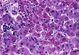 Ebola virus disease has also caused intermittent outbreaks with high mortality rates since 1976 when it was first identified. File Marburg Virus Liver Injury Jpg Wikimedia Commons