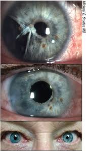The Artificial Iris In Practice