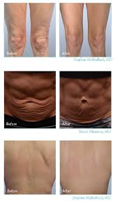 How long it takes for collagen supplements to work depends on many factors including age, dosage, diet and lifestyle, and individual collagen needs. Plus Cellulite Reduction Skin Tightening Naturopathic Functional Medicine Holistic Family Practice