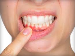 Gum Disease: Can a Simple Cavity turn ...