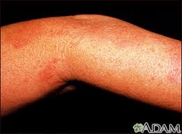 Spanish Hie Multimedia Herpes Zoster Culebrilla En El Brazo